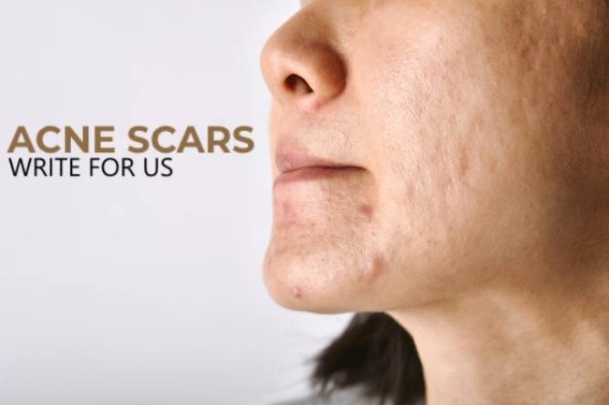 Acne Scars Write For Us