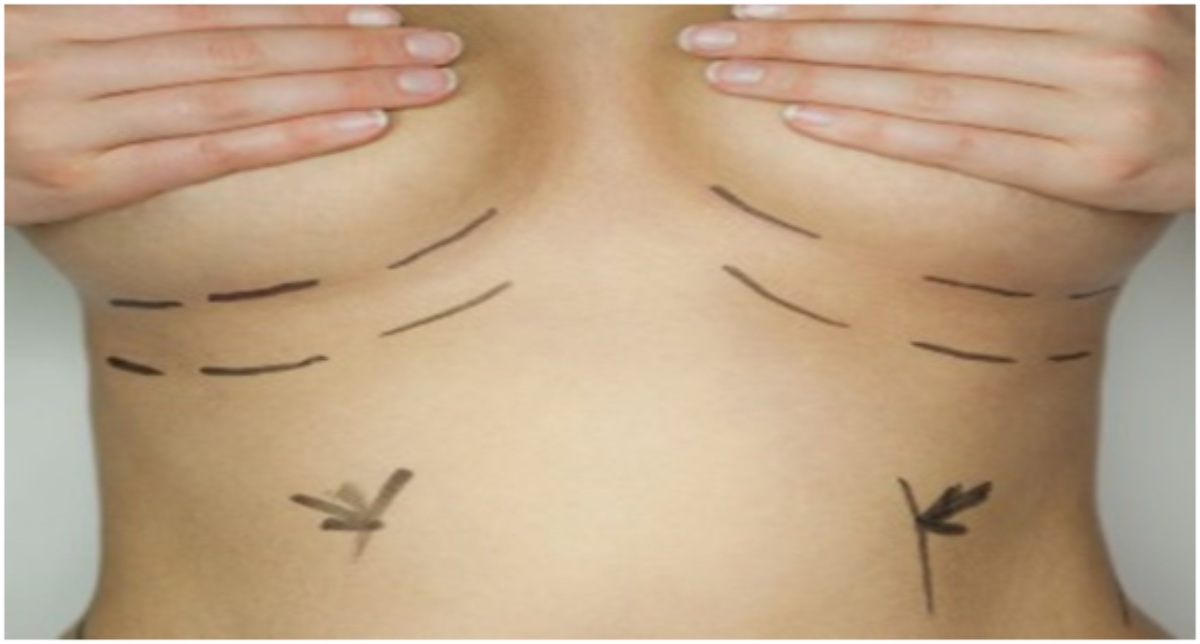 breast reduction surgery