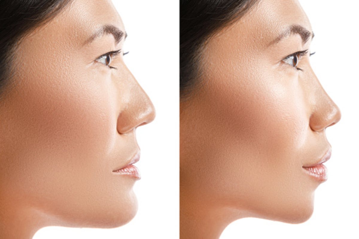 What is Asian Rhinoplasty?