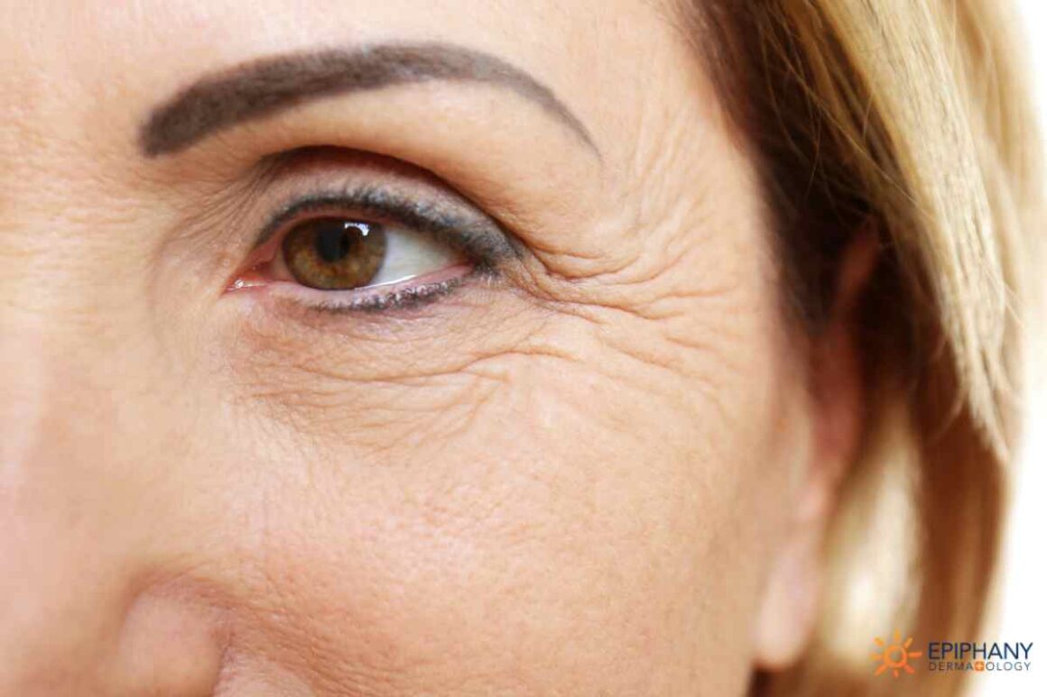 wrinkles