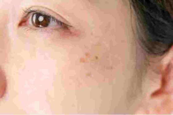 dark spots