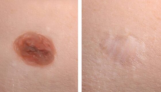 Complete Guide to Safely Removing Moles - Professional Techniques and Care